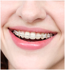 Invisalign Before and After Pictures in Atlanta, GA - Smile Envy Dental &  Orthodontics