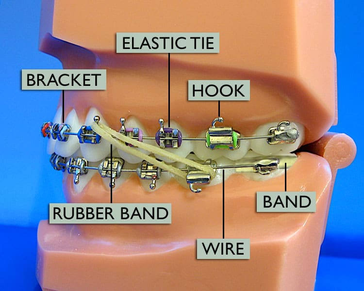 elastic tie braces