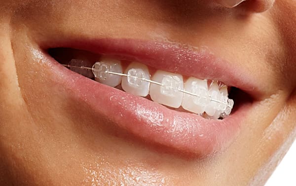 https://www.drwrightortho.com/wp-content/uploads/2014/03/ceramic-braces-image.jpg