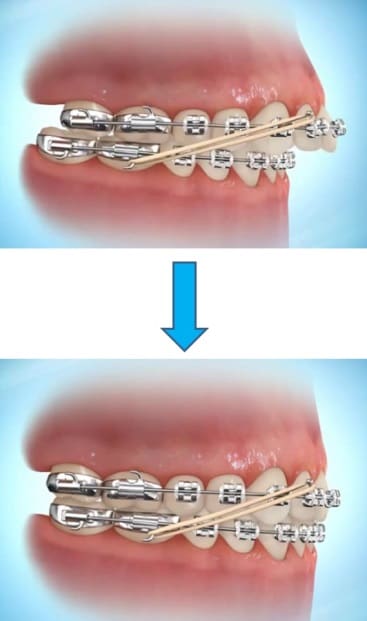 braces without elastics