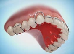 Orthodontic Retainers in Atlanta and Marietta, GA