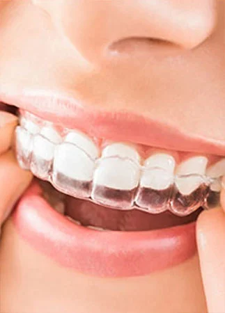 Invisalign® in Atlanta and Marietta, GA