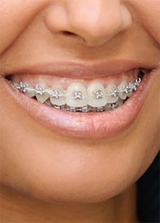 Metal Braces in Atlanta and Marietta, GA