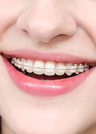 Braces in Atlanta and Marietta, GA