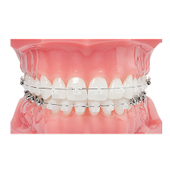 SureSmile Customized Arch wires for Braces